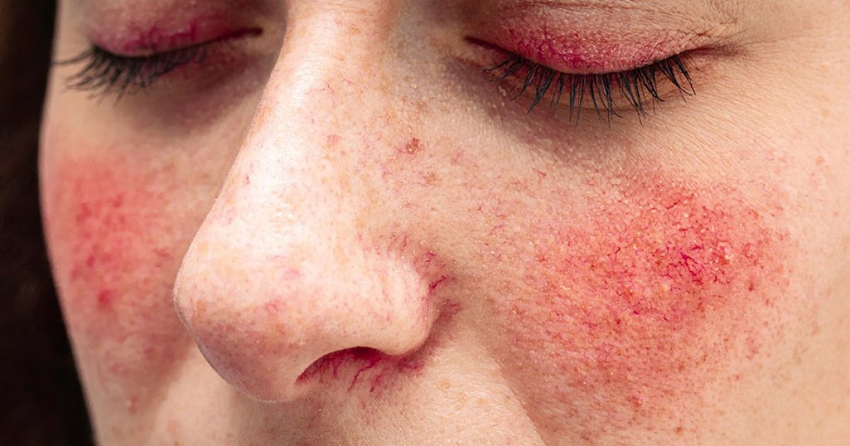 Rosacea